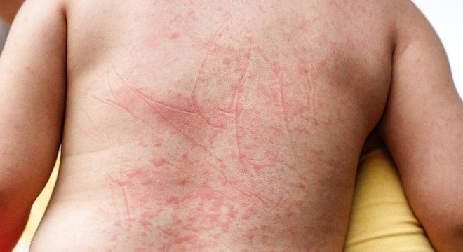 Conheça quais são os sintomas da dengue saiba como tratar