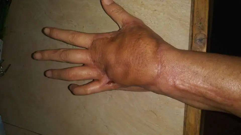 Resultado de imagem para Mulher corta a mão com papel e quase morre infectada por bactéria
