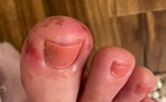 As lesões são mais comuns nos dedos dos pés e podem ter a coloração vermelha ou roxa e apresentar pus 