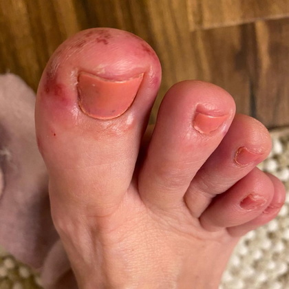 As lesões são mais comuns nos dedos dos pés e podem ter a coloração vermelha ou roxa e apresentar pus 