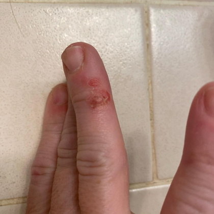 Os 'dedos de Covid' aparecem, geralmente, de uma a quatro semanas após as pessoas serem infectadas e, embora possam afetar qualquer um, eles são mais comuns entre crianças e adolescentes. Segundo especialistas, normalmente desaparecem sem a necessidade do uso de medicamentos