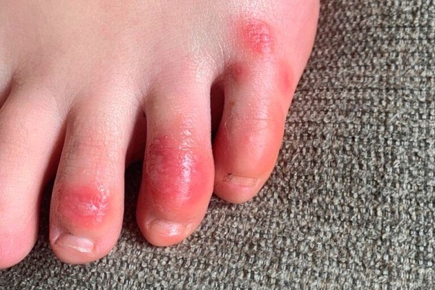 Os 'dedos de Covid', lesões nas mãos e nos pés parecidas com frieiras, aparecem em alguns pacientes infectados com Covid-19 e podem ser efeito da resposta do sistema imunológico ao coronavírus. Essa foi a conclusão de um estudo feito pela Universidade de Paris e publicado no British Journal of Dermatology