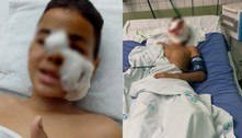 Criança de 10 anos tem orelha decepada ao ser atacada por pitbull no interior de São Paulo