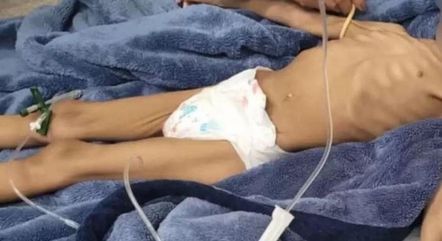 Garota de três anos foi encontrada desnutrida após pai negligenciar alimentação
