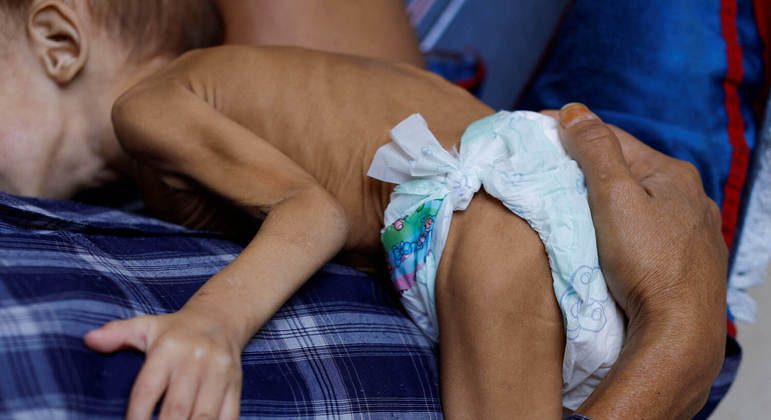 Crianças yanomamis com desnutrição grave estão conseguindo ganhar peso