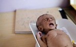 criança desnutrida no yêmen