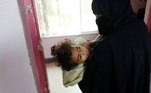 mãe leva criança desnutrida para hospital do Iêmen