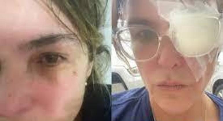 Cristiana Oliveira sofre acidente nos olhos