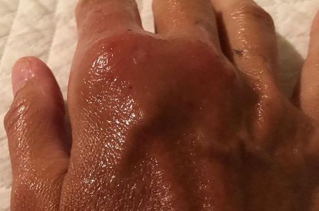 Daniela mostrou como ficou a mÃ£o apÃ³s mordida