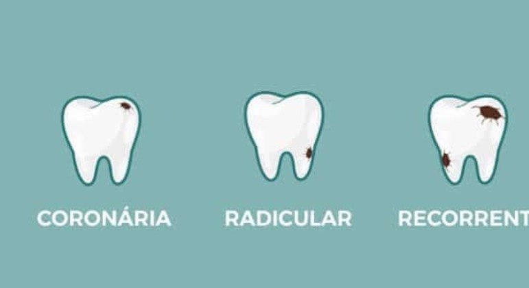 Dente cariado - principais sintomas e tratamentos para remoção