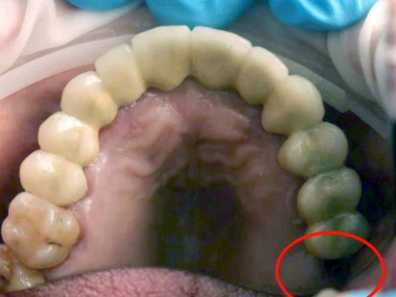 Meu tumor TERATOMA voltou novamente após três meses da cirurgia