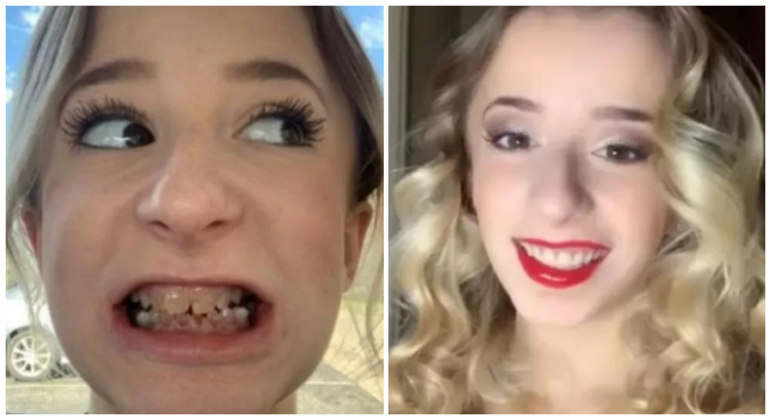 Jovem com dentes 'transparentes' gasta 
quase R$ 50 mil para ter novo sorriso
