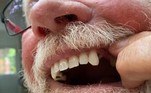 Esse é o caso de Debroy Parrington, que usou um alicate para arrancar o próprio dente, além de um alfinete esquentado no fogão para furar uma bolha de pus