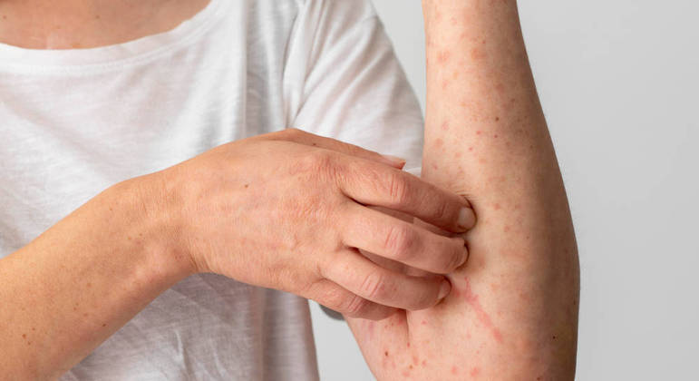 Irritação e vermelhidão são sintomas de dermatite atópica