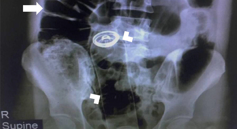 Radiografia  abdominal revelou presença de corpo estranho no reto do paciente