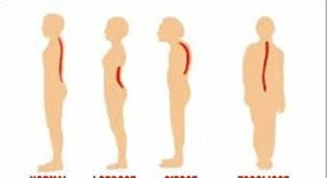 Diferenças da escoliose para cifose e lordose