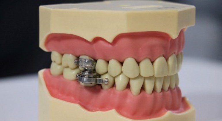 Os ímãs são aplicados nos dentes molares e impedem que mandíbulas abram mais do que 2mm