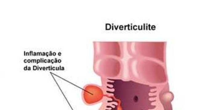 Diverticulite - O que é, quais os sintomas e tratamentos?