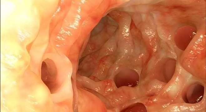 Diverticulite - O que é, quais os sintomas e tratamentos?