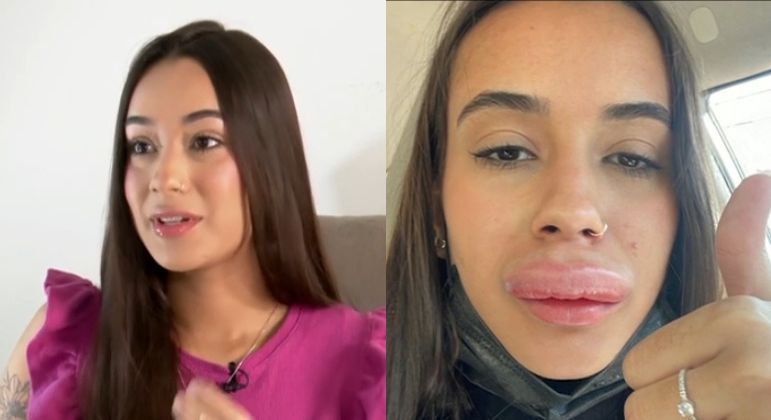 Iris de Oliveira, de 20 anos, precisou de injeções para controlar a alergia depois de realizar um preenchimento labial