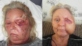 Woman loses half her face after being infected with flesh-eating bacteria
