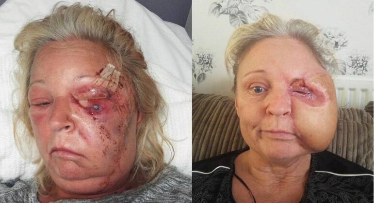 Donna já passou por mais de 15 cirurgias reparadoras após ter perdido metade do rosto