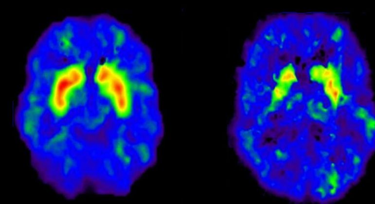 Dopamina - função, efeitos e como aumentar a produção no organismo