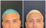 Dynho Alves fez sua mais recente harmonização facial em agosto deste ano. Ele contou a novidade em suas redes sociais e publicou a montagem acima. 