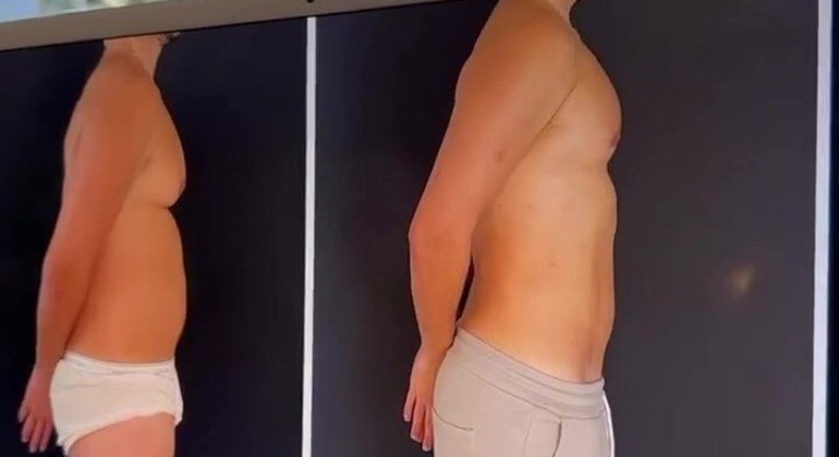 Eliezer antes e depois da cirurgia de ginecomastia com lipoaspiração