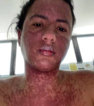 Ela publicou fotos mostrando feridas vermelhas e descamação pelo seu pescoço, rosto, boca, costas e tórax.