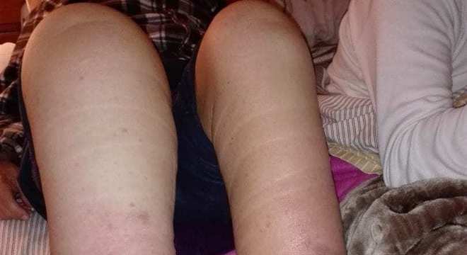 Elefantíase - o que é? Causas, sintomas e tratamento da doença