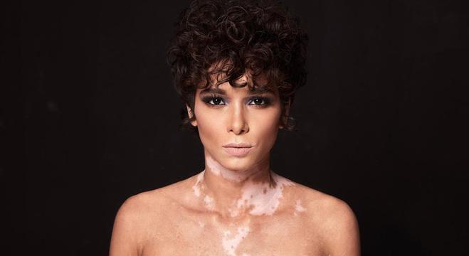 A modelo Eliane Medeiros parou de lutar contra o vitiligo e se aceitou como é