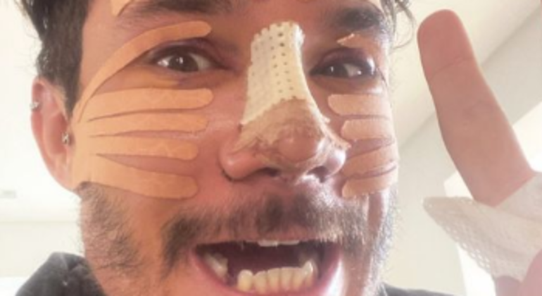 Sem dente, Eliezer aparece com o rosto cheio de curativos após rinoplastia