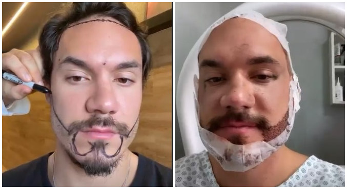 Eli mostrou detalhes do procedimento de transplante de cabelo e barba