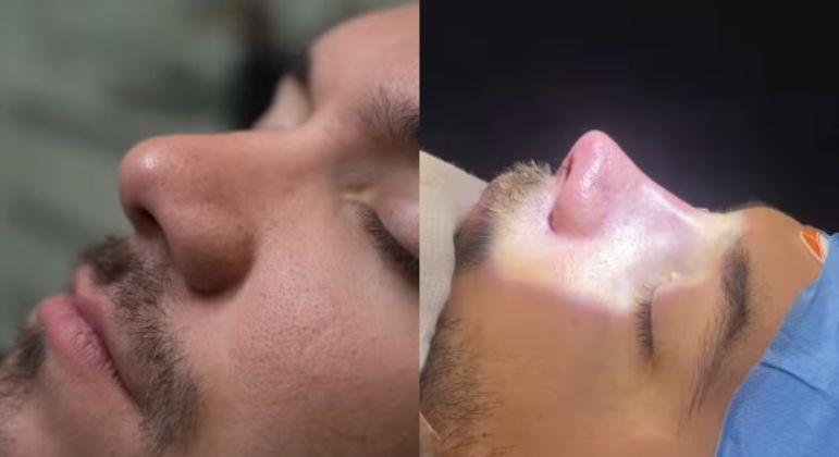 Antes e depois da rinoplastia de Eliezer