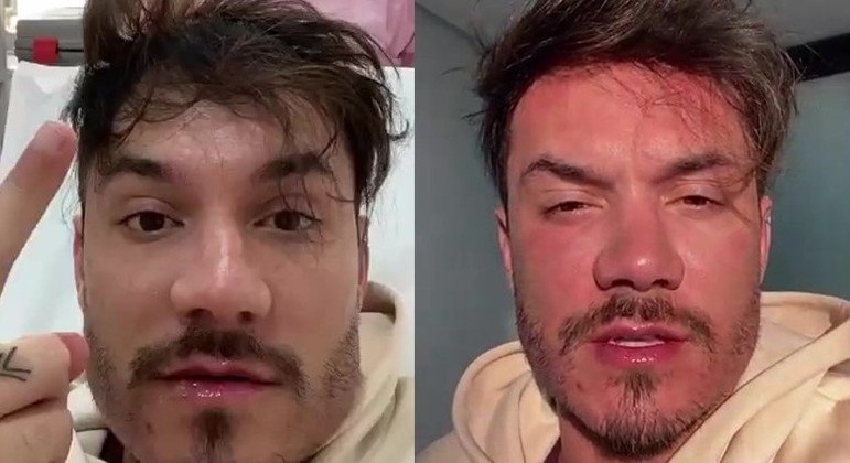 Eliezer fez a segunda sessão para aplicar laser no rosto nesta quarta-feira (31)