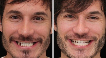 Eliezer, antes e depois de tratamento dentário