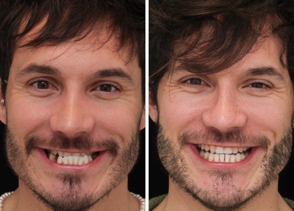 Eliezer mostra antes e depois de tratamento dentário