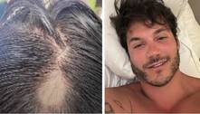 Eliezer revela que sofreu alopecia após ataques na web: 'Buracos na cabeça'