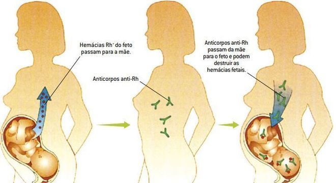 eritroblastose fetal