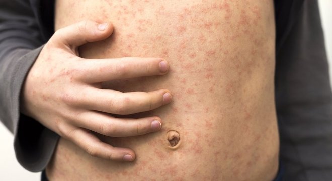 As manchas vermelhas são o sintoma mais óbvio do sarampo