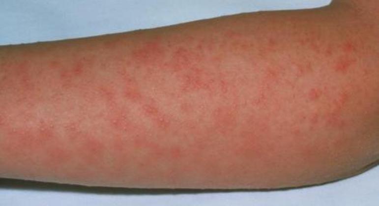 Lesões de pele ocorrem em pacientes com escarlatina