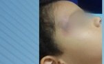 Em 2014, antes das denúncias terem ganho repercussão, uma mãe tirou o filho da escola Colmeia Mágica depois de perceber alguns hematomas no corpo da criança. 'Meu filho ficava muito retraído quando eu ia deixá-lo. Ele se agarrava com toda a força em mim, não queria ficar de jeito nenhum, chorava bastante. Tinha vezes que chegava em casa com hematomas', contou a mulher