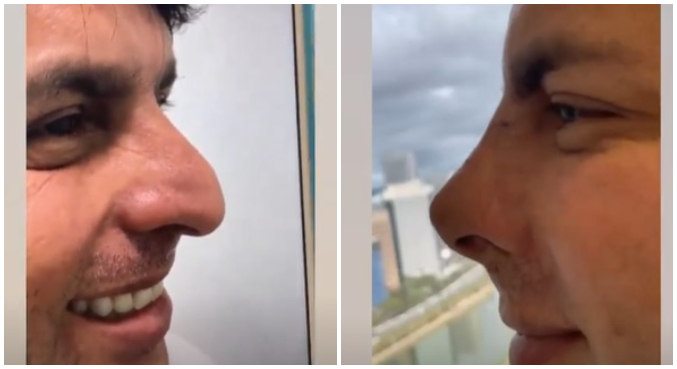 Antes e depois do nariz de Esdras de Souza