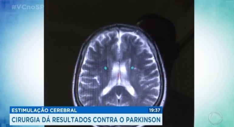 Como a doença de Parkinson se espalha no cérebro? - Blog Cirurgia