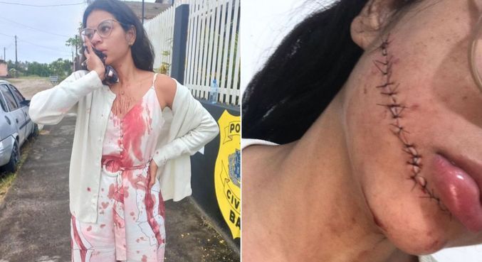 Estudante Stefani Firmo levou 18 pontos no rosto após o ataque