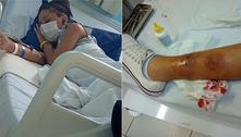 Menina de 14 anos é picada em atividade escolar em Caieiras (SP) e corre o risco de perder a perna
