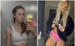 Alix Small, uma escocesa de apenas 21 anos, revelou, em entrevista ao Daily Mail, que ficou tão doente por conta de anorexia que chegou ao ponto de pesar apenas 31 quilos, recusando-se até mesmo a mascar chiclete com medo de engordar