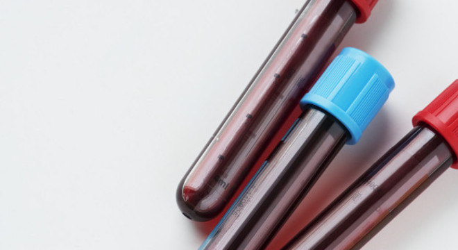 Para ser um candidato a doador de medula, é feita uma coleta de 20 ml de sangue