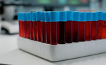 Vitamina B12A vitamina B12 é essencial para diversas funções do corpo, incluindo a formação de glóbulos vermelhos, o funcionamento do sistema nervoso e a síntese de DNA. O exame de vitamina B12 é indicado especialmente para pessoas que apresentam sintomas sugestivos de deficiência, como fadiga persistente, fraqueza, formigamento nas extremidades, confusão mental e dificuldade de concentração. Também pode ser solicitado para monitorar a eficácia do tratamento em pessoas que estão recebendo suplementação de vitamina B12 ou que têm condições médicas que podem afetar a absorção dessa vitamina, como a doença de Crohn, anemia perniciosa ou cirurgia bariátrica